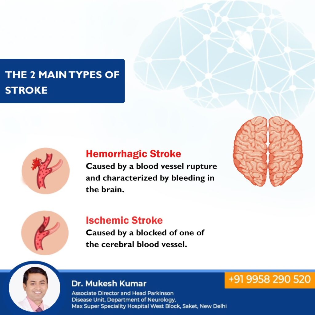 stroke rehabilitation doctor in Delhi 