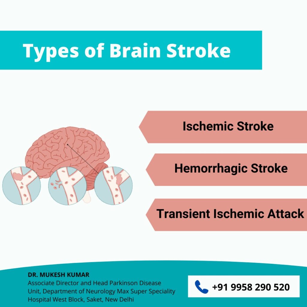 Stroke specialist doctor in Delhi 