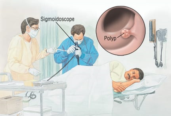 sigmoidoscopy