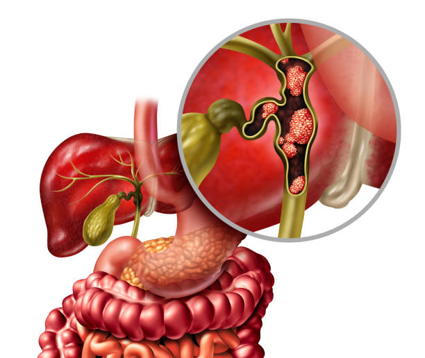 Gallbladder Treatment in delhi ncr